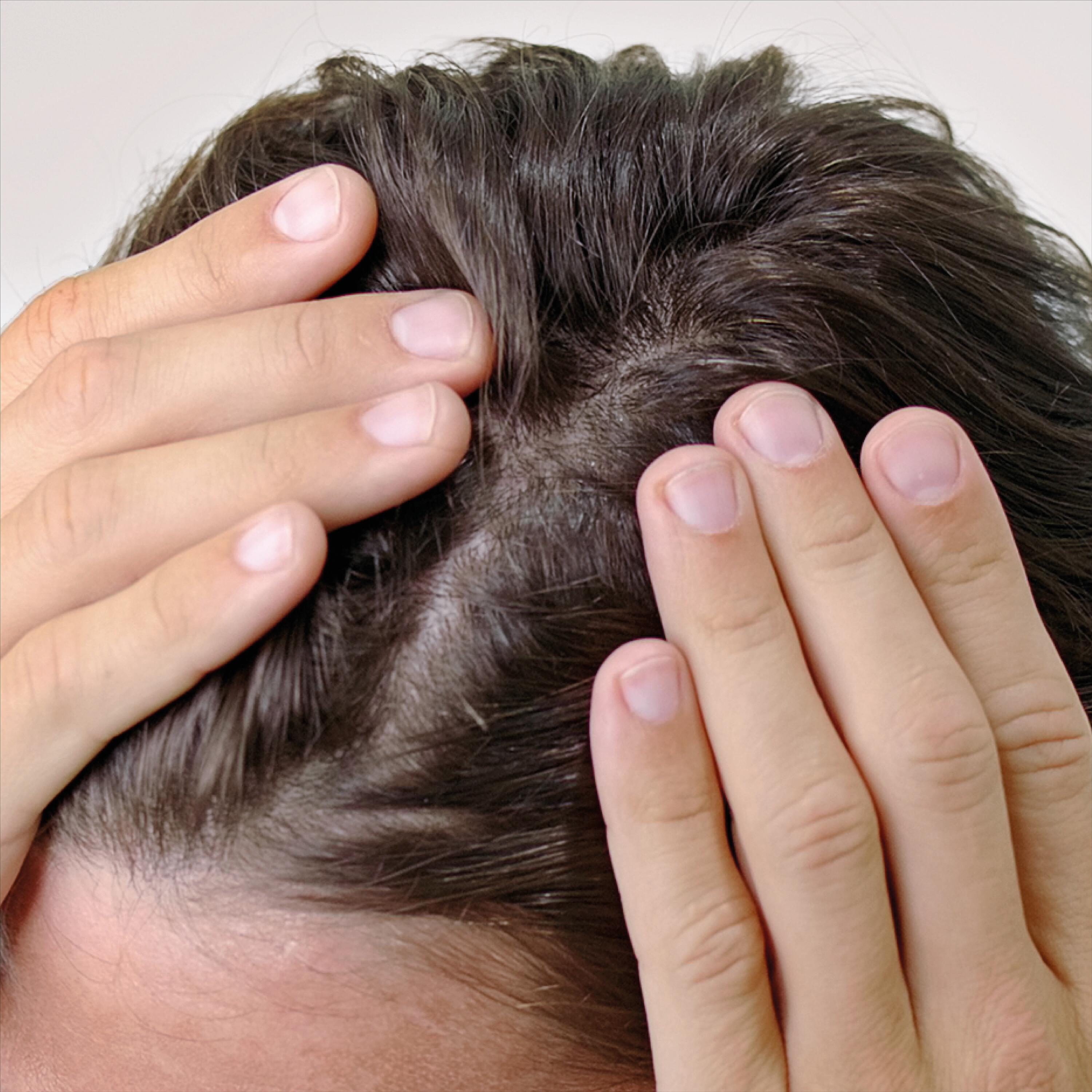 Causes des cheveux clairsemés